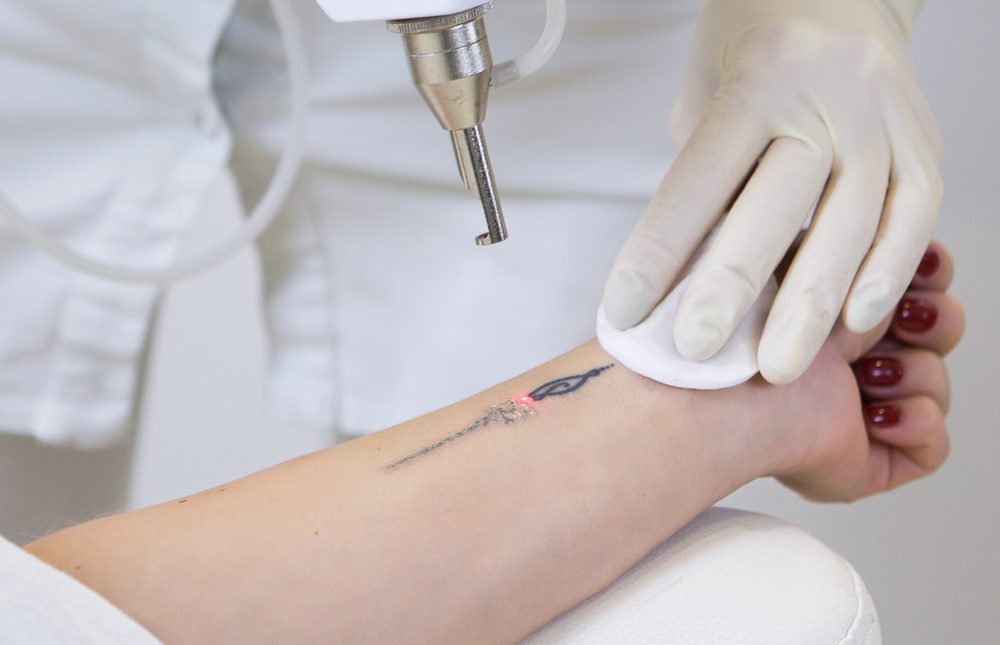 Nowoczesne techniki usuwania tatuażu - Odzwierciedlenie na skórze zawsze jest możliwe